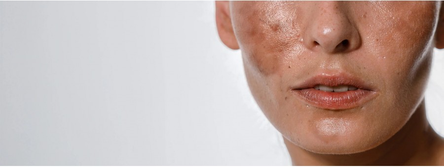 Hyperpigmentation and Treatments