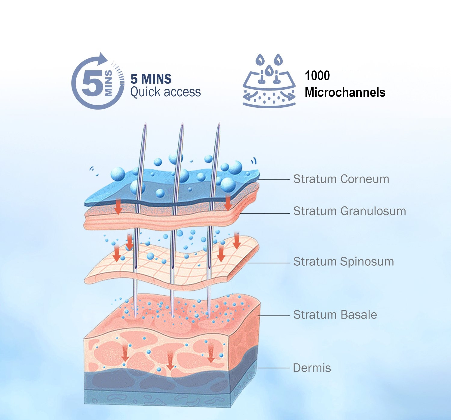 spicule-infusion Exo-Matrix 1000 - Görsel 2
